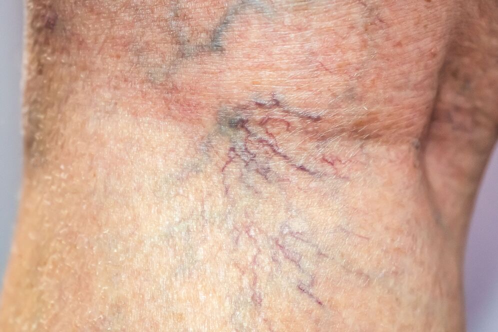 varicose veins in the body