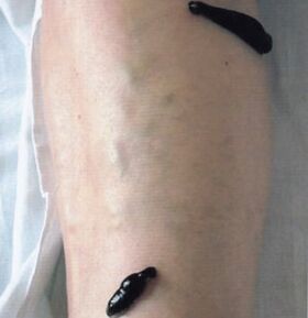 Hirudotherapy as a method to treat varicose veins