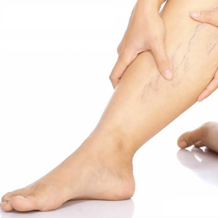 varicose veins in the legs
