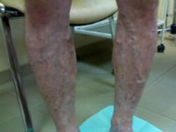 Varicose veins in the legs.