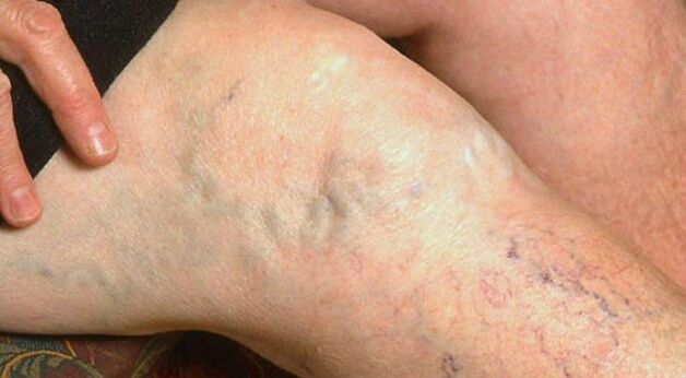 Visible symptoms of varicose veins in the legs.