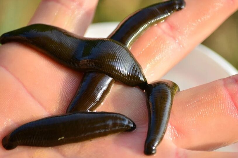 Leeches will help in the fight against varicose veins.