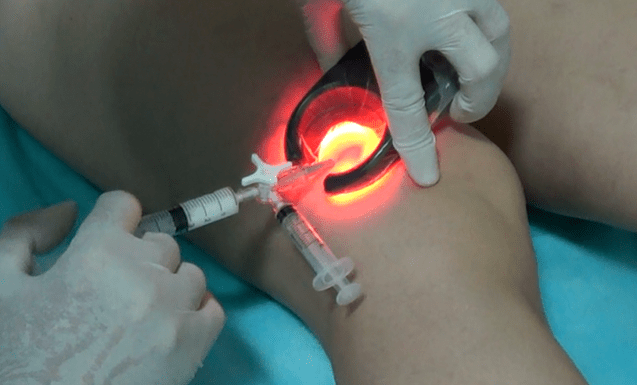 Sclerotherapy is an effective method to treat varicose veins in the legs.