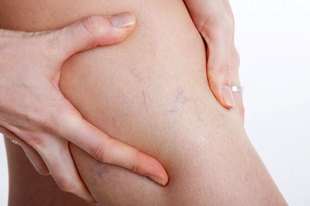 The first appearances of varicose veins in the leg.
