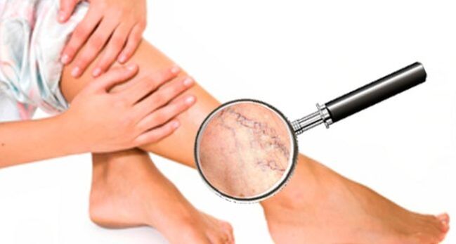 Varicose veins in the legs.